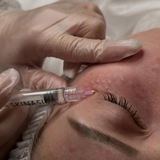 МЕЗОТЕРАПИЯ ЗОНЫ ГЛАЗ С PDRN